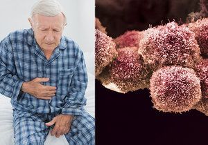 Rakovina slinivky je jednou z nejzákeřnějších chorob (ilustrační foto)