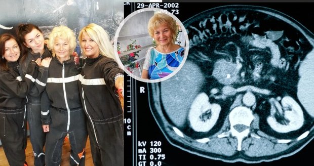 Paní Soňa se díky včasnému zásahu lékařů z rakoviny slinivky vyléčila.