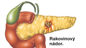 Rakovina slinivky