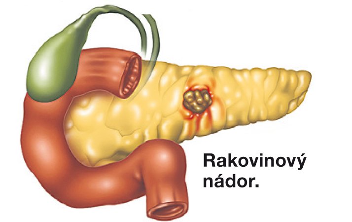 Rakovina slinivky břišní