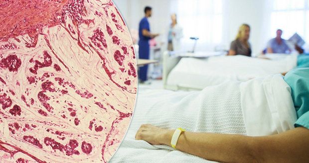 V Česku funguje registr, který hledá osoby s extrémně vysokým rizikem onemocnění kolorektálním karcinomem.