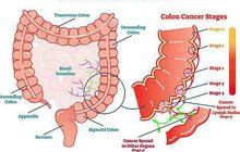 Březen je měsíc prevence rakoviny tlustého střeva: Zjistěte nádor zdarma!