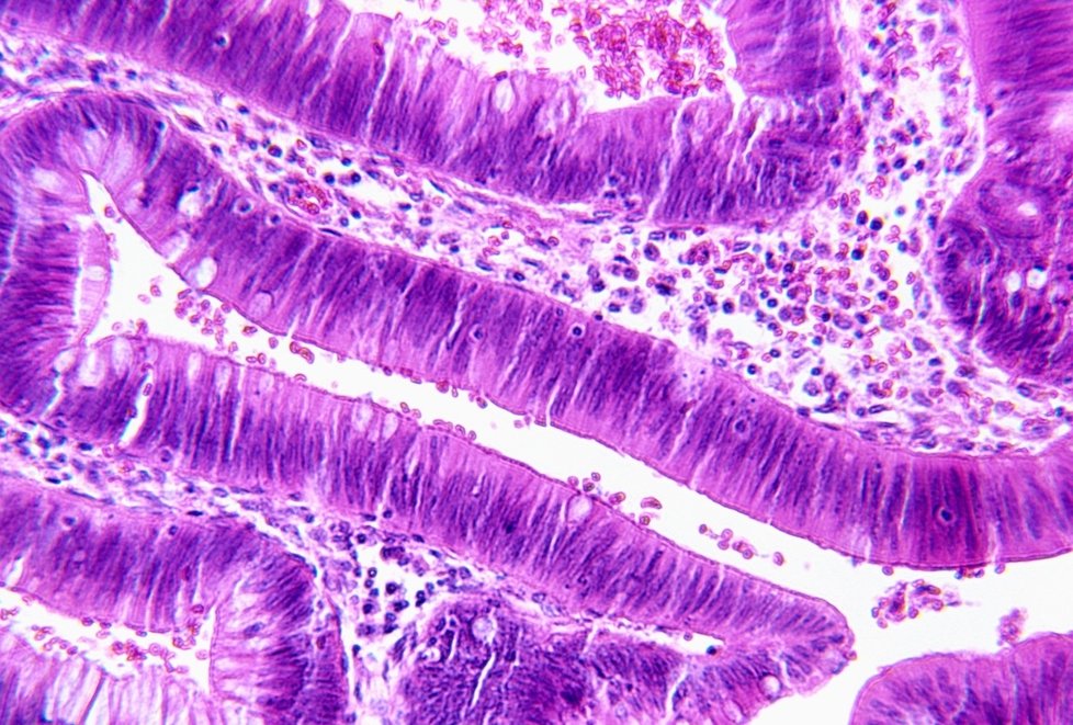 Rakovina tlustého střeva pod mikroskopem.
