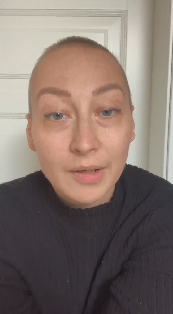 Katarína bez vlasů po chemoterapii