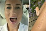 Charlotte Websterová-Salterová (27) prodělala rakovinu ústní dutiny. Lékaři jí vytvořili novou část jazyka z ženina stehna.