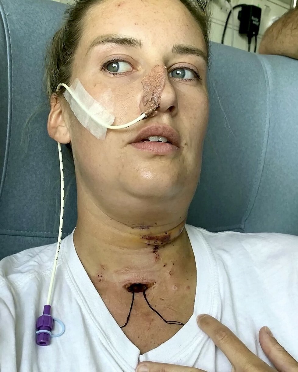 Charlotte Websterová-Salterová (27) prodělala rakovinu ústní dutiny. Lékaři jí vytvořili novou část jazyka z ženina stehna.