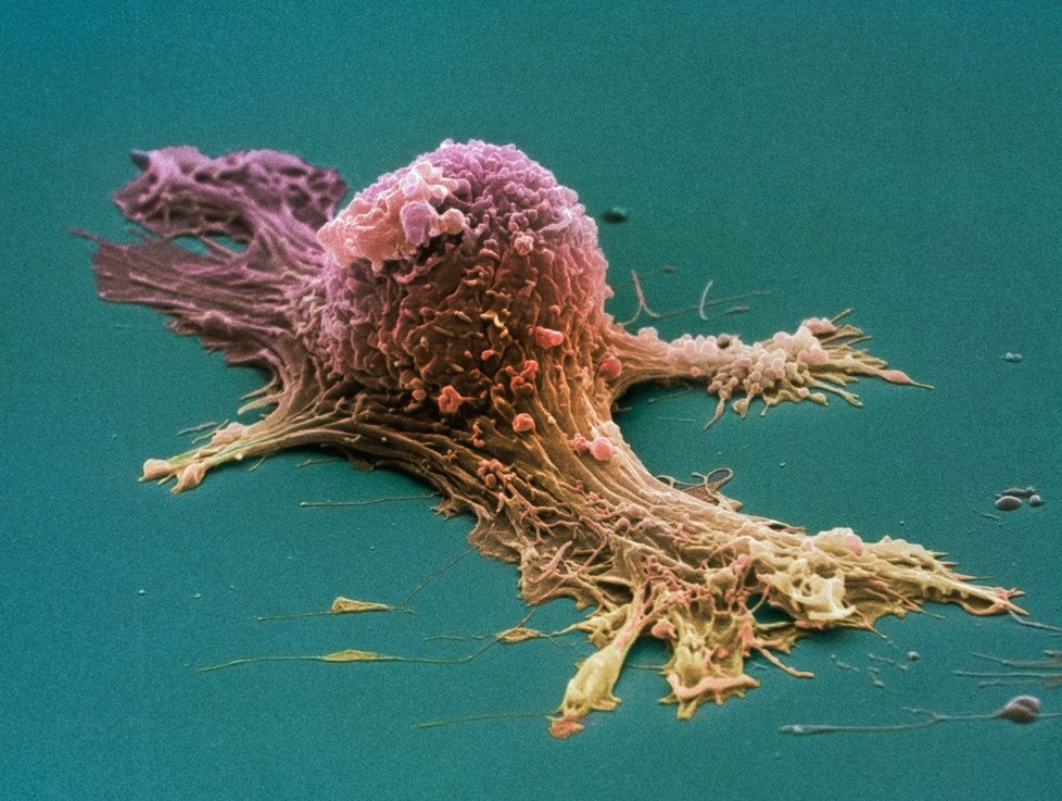 Rakovina vaječníků