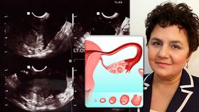 Lékařka Sausen přežila rakovinu vaječníků: Tichý zabiják roste nenápadně, varuje!