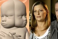 Hrozivá diagnóza rodiče neodradila: Čekají dítě se dvěma obličeji, ale potrat odmítli!