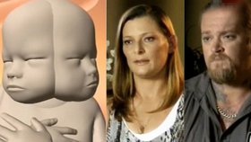 Rodiče potrat zamítli, chtějí miminko i se dvěma oobličeji.