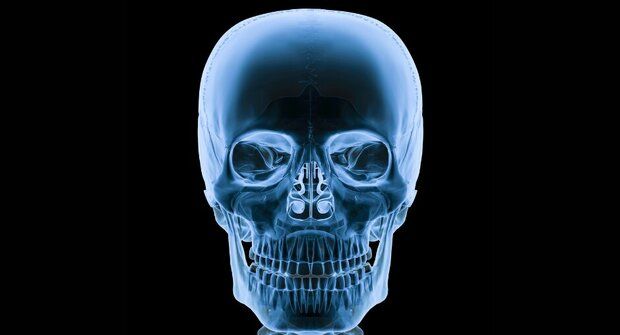 Kolik rentgenů je smrtící dávka?