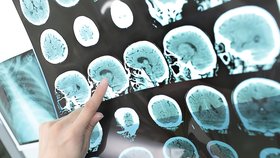 Pomocí rentgenu lékaři dokáží zjistit, které oblasti mozku mohou být poškozené (ilustrační foto.)