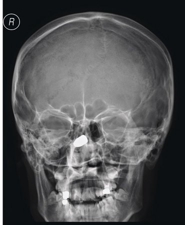 Rentgenový snímek Danielovy hlavy. Kulka v oblasti nosu je dobře vidět.