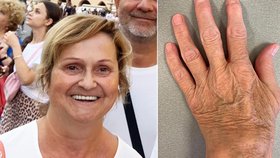 Romana (57) trpí revmatoidní artritidou už 36 let