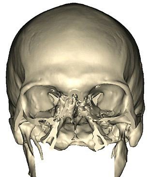 Počitačová studie Richardovy lebky po zranění.