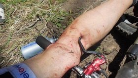 Cyklista si propíchl nohu řidítky: Je to podvod! nevěří drastické nehodě lidé