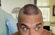 Robbie Williams přiznal, že mu řídnou vlasy