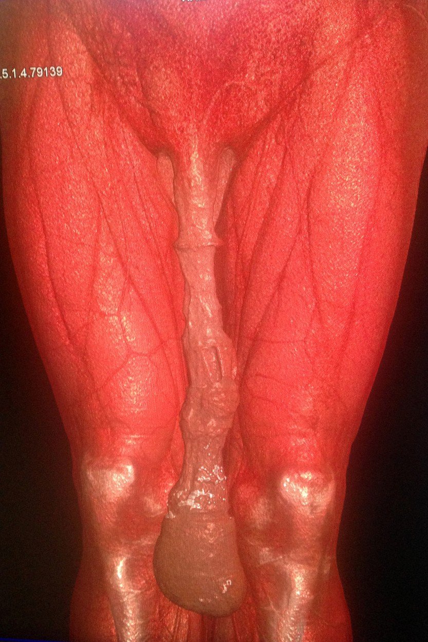 Velkou část Mexičanova penisu tvoří vytahaná předkožka.