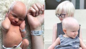 Rodičům se narodil albínský synek: Výsměch lidí na internetu je zdrtil