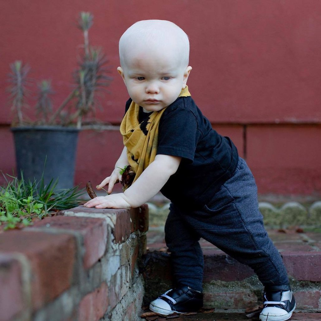 Albinismus: Co to je, proč vzniká a jak vypadá?