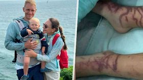 Chlapeček zemřel po žahnutím medúzou na exotické dovolené