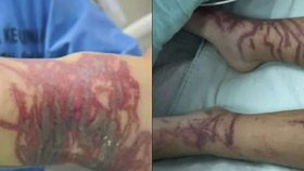 Malého Vovíka na dovolené požahala smrtelně jedovatá medúza