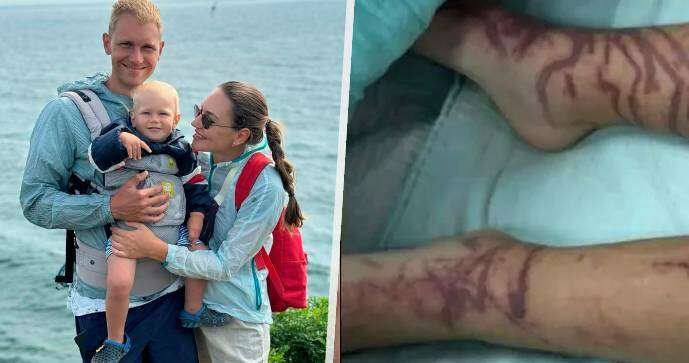 Chlapeček zemřel po žahnutím medúzou na exotické dovolené