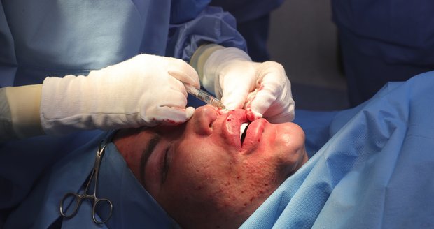 Živý Ken Rodrigo Alves se v Praze podrobil operaci obličeje.