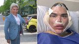 Ken Rodrigo Alves zveřejnil děsivé fotky obličeje! Lifting pomocí nití se mu krutě vymstil