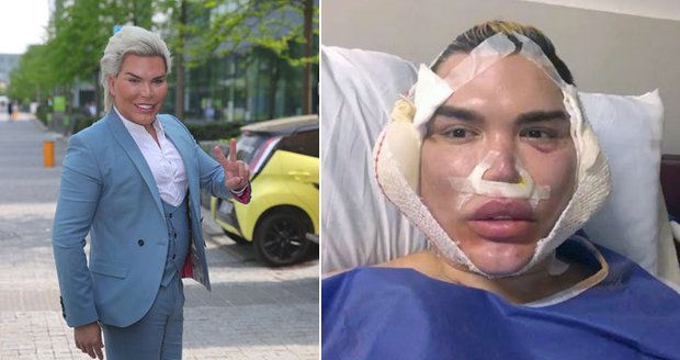 Ken Rodrigo Alves zveřejnil děsivé fotky obličeje! Lifting pomocí nití se mu krutě vymstil