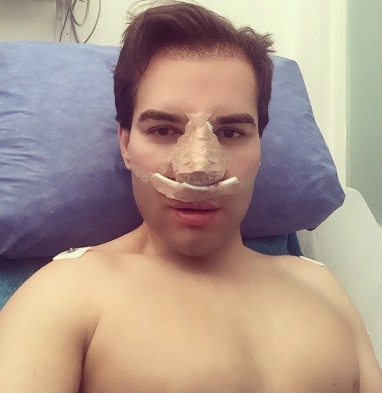 Rodrigo Alves podstoupil několikrát operaci nosu, přinejmenším už osmkrát.