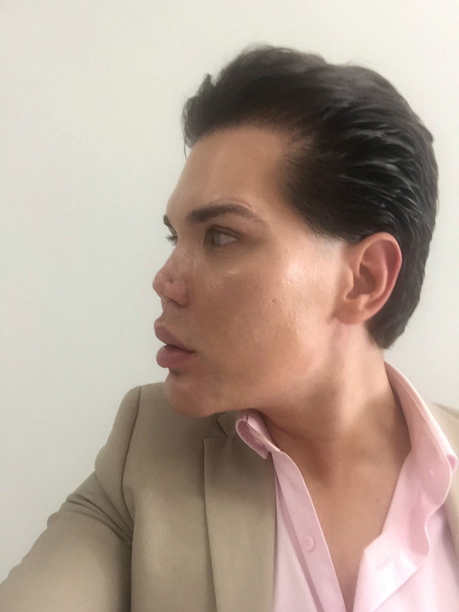 Rodrigo Alves po poslední plastice. V nose se mu udělala díra.