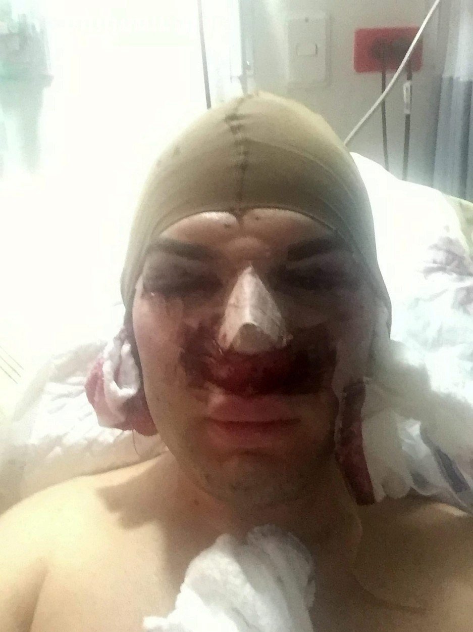 Rodrigo Alves skončil po  plastice nosu v nemocnici.