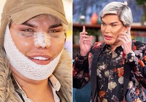 »Lidský Ken« Rodrigo Alves pláče: Rozpadá se mu nos!