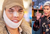 »Lidský Ken« Rodrigo Alves pláče: Rozpadá se mu nos!