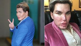 Rodrigo Alves děsí fotkou po kosmetické úpravě.