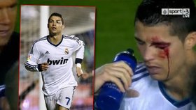 Zkrvavený Ronaldo: Dal gól, ale neviděl a musel ze hřiště!