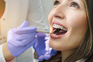 Jaké jsou nové trendy v ortodoncii? A kdy platí rovnátka pojišťovna?
