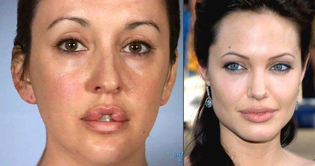 Chtěla mít rty jako Angelina Jolie: Už 10 let nemůže zavřít ústa