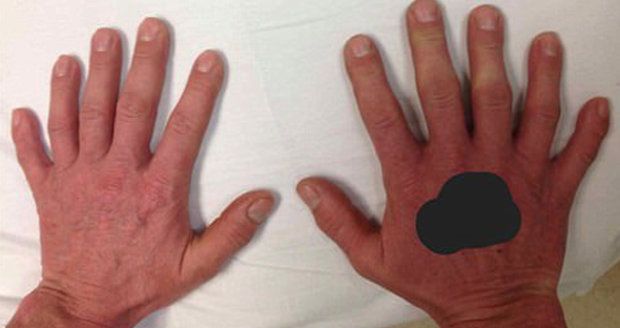 Muž má na každé ruce šest prstů, narodil se s vrozenou vadou polydaktylií.