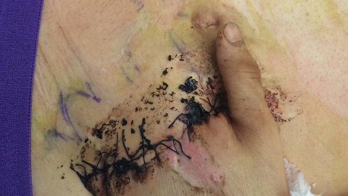 Rozdrcenou ruku všili lékaři mladému muži do oblasti břicha. Rozdrcenou ruku všili lékaři mladému muži do oblasti břicha.