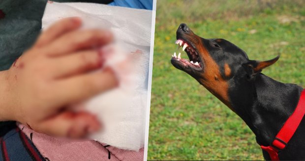 Pes uhryzl chlapečkovi (2) prsty na ruce: Lékaři dítě operovali 12 hodin!