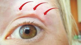 Žena (32) zvláštní útvary nejdříve zpozorovala pod levým okem, ty se po pěti dnech přesunuly nad levé oko.