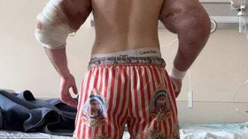 Ruský „Pepek Námořník“ si do svalů píchal vazelínu: Lékaři teď mluví o amputaci ruky!