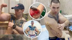 Ruský „Pepek Námořník“ si do svalů píchal vazelínu: Lékaři teď mluví o amputaci ruky!