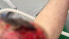 Ruský „Pepek Námořník“ si do svalů píchal vazelínu: Lékaři teď mluví o amputaci ruky!