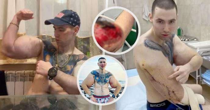 Ruský „Pepek Námořník“ si do svalů píchal vazelínu: Lékaři teď mluví o amputaci ruky!