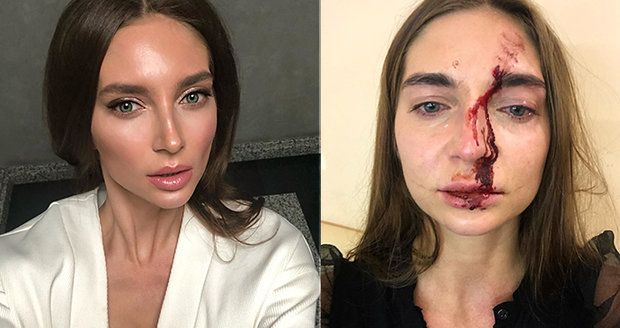 Plastická chirurgie z pekla: Lékařka napadla herečku při výplni rtů jejím vlastním mobilem