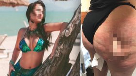 Velislava Grigorieva (40) z Ruska se rozhodla podstoupit liposukci a odstraněný tuk si nechala dát do hýždí.