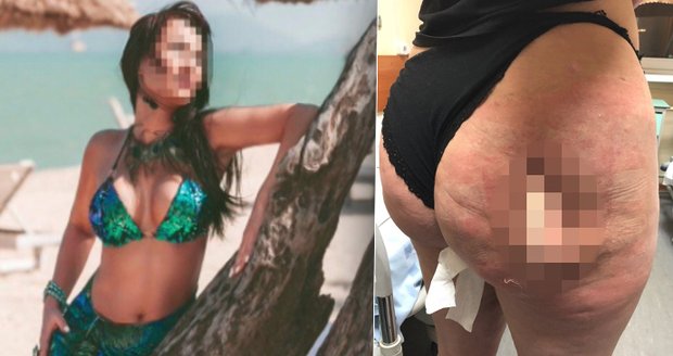 Chtěla zadek jako Kim Kardashian, teď chystá žalobu. Žena (40) přišla o celou půlku!